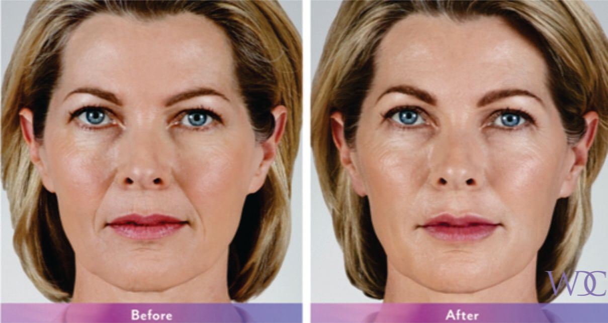 What facial fillers are best?