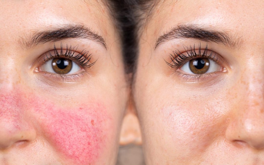 Coping with Rosacea