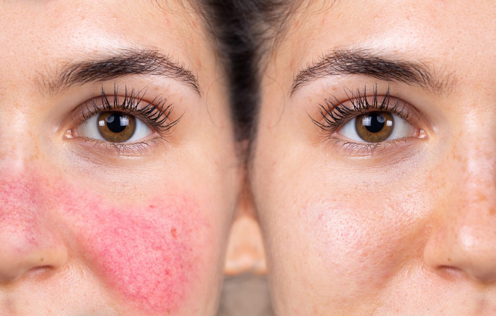 HOW TO COPE WITH ROSACEA