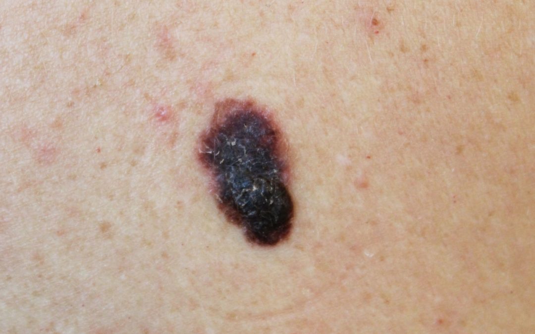 Melanoma and Skin Cancer Awareness