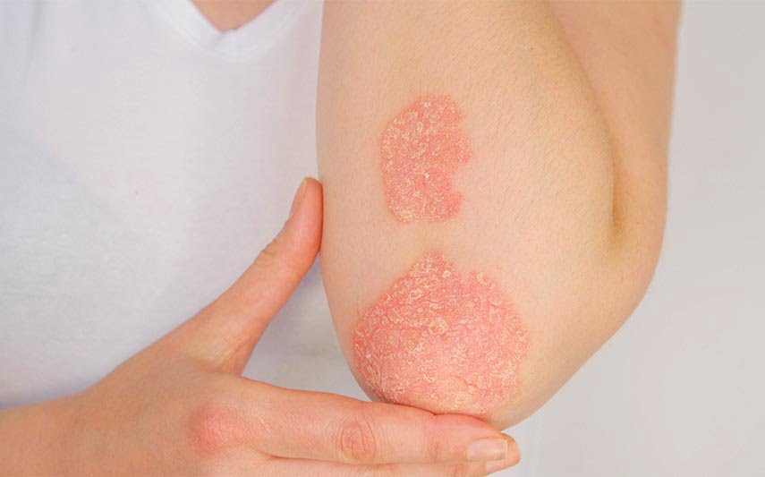 Everything You Need to Know About Psoriasis and Treatment Options