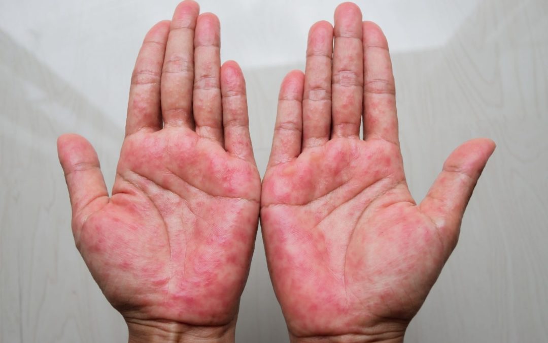 How Do I Know If I Have Atopic Dermatitis (Eczema)?