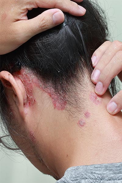 Everything You Need to Know About Psoriasis and Treatment Options