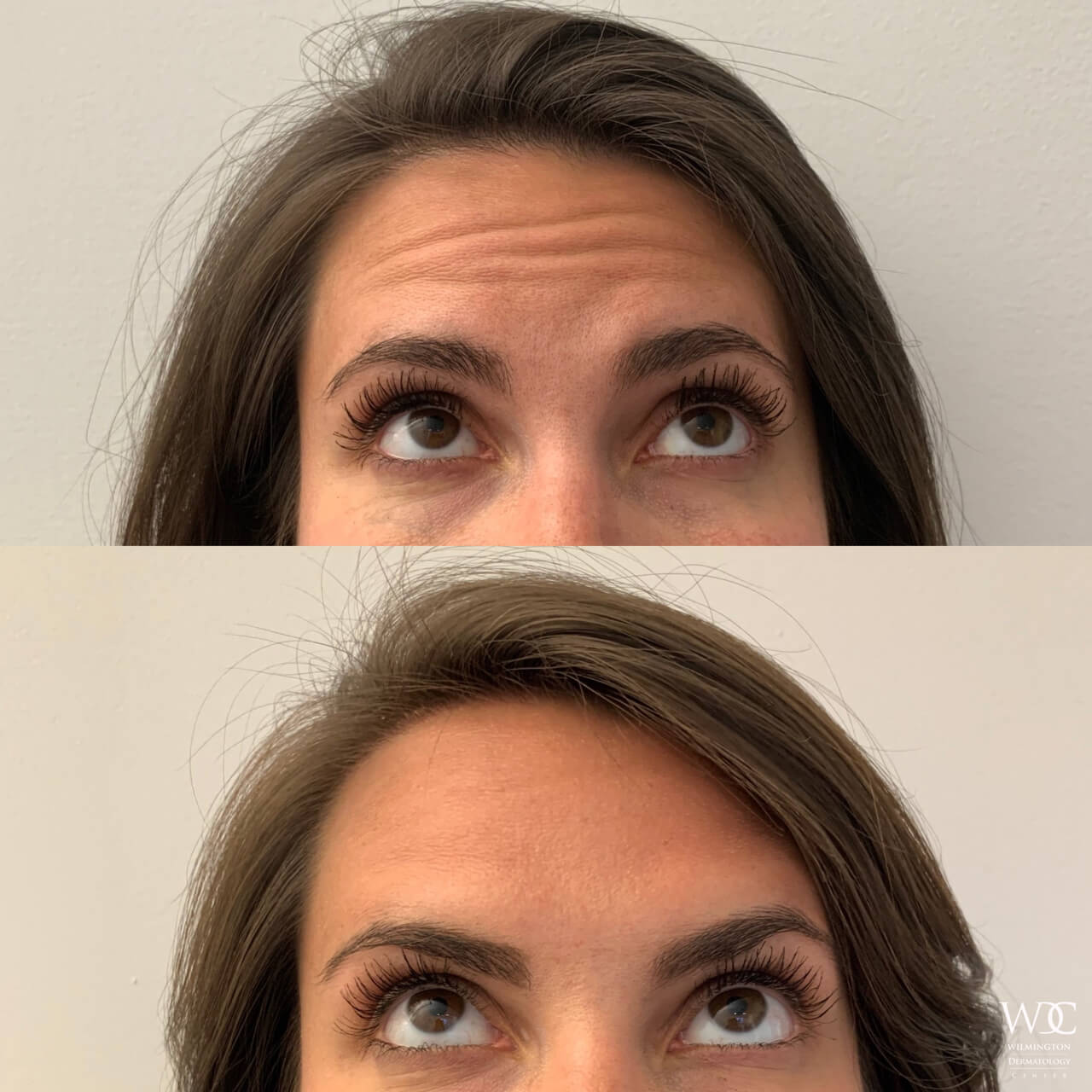 BOTOX Before and After Results