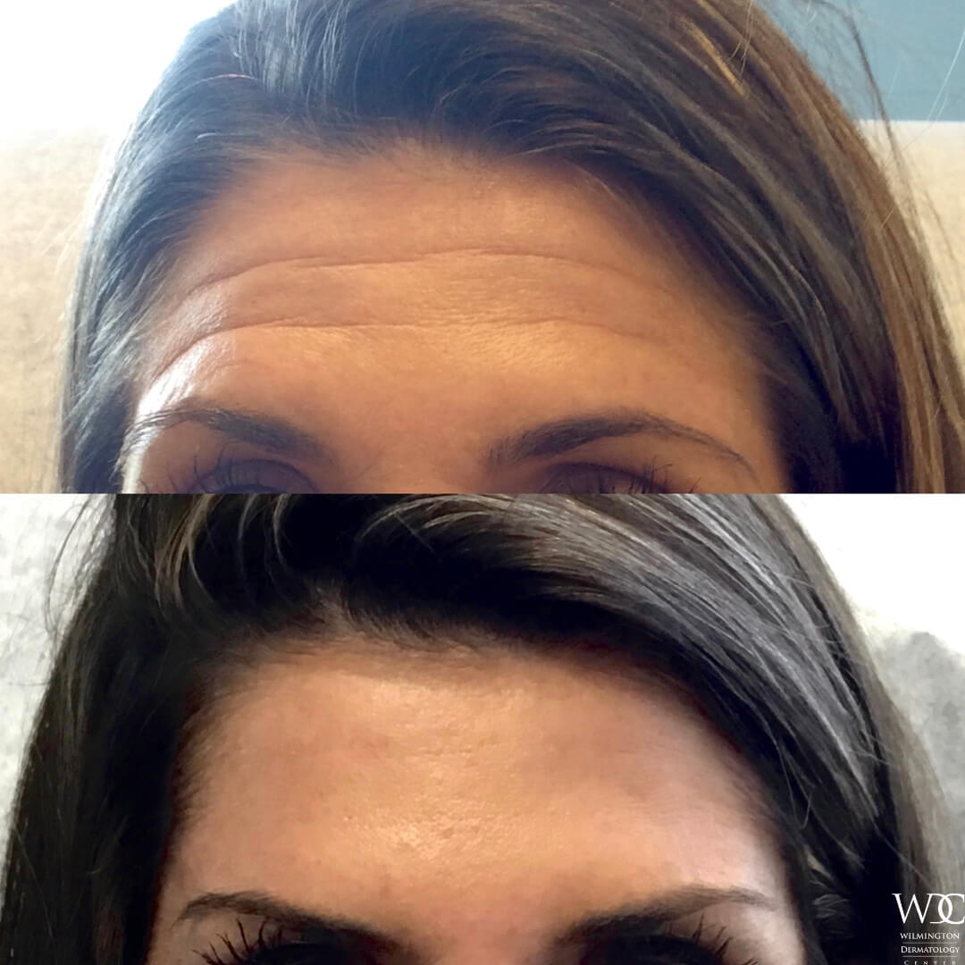 BOTOX Before and After Results