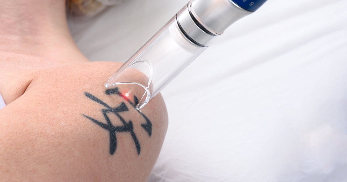 Tattoo Removal Treatment in Wilmington, NC