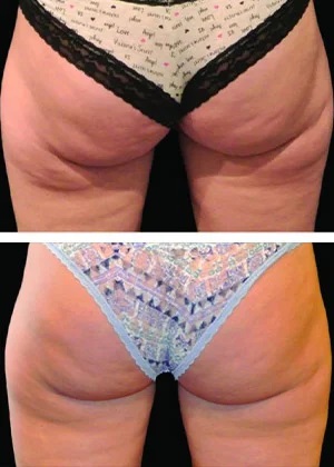 CoolSculpting Before and After at Wilmington Dermatology Center