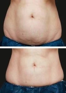 CoolSculpting Before and After at Wilmington Dermatology Center