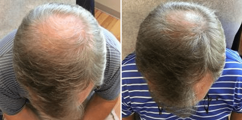 Hair Loss Treatments Before and After