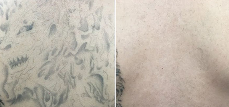 Tattoo Removal in Wilmington, NC