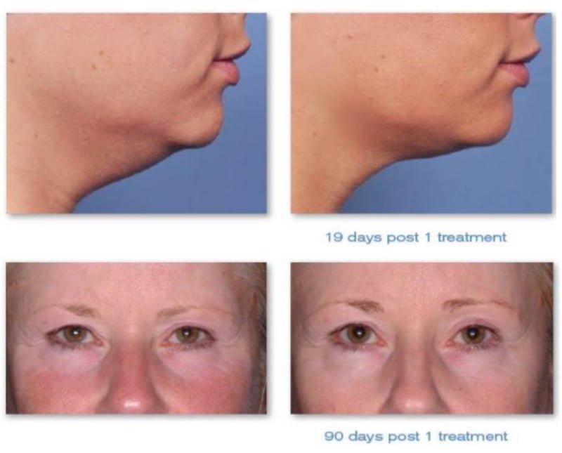 Ultherapy Before and After Results