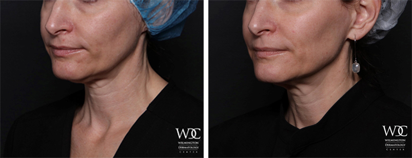 Wrinkles and Skin Tightening  Wilmington Dermatology Center