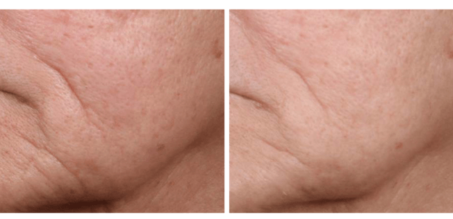 Before and After an ellacor treatment