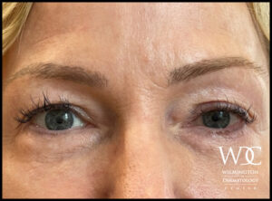 Before and After of a Female After One Dose of Upneeq in Wilmington Dermatology Center