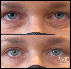 Before and After of a Male After One Dose of Upneeq in Wilmington Dermatology Center