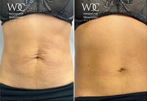 VirtueRF Before and After Photo at Wilmington Dermatology Center