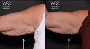 VirtueRF Before and After Photo at Wilmington Dermatology Center