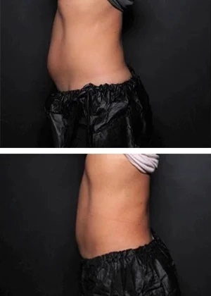 CoolSculpting Before and After at WDC